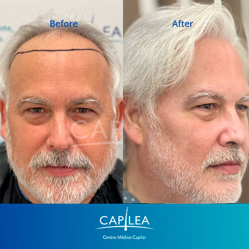 Capilea Mexico Celebrates 11,550 Successful Hair Graft Patients, Highlighting Mexico as a Safe Premier Destination for Hair Transplants