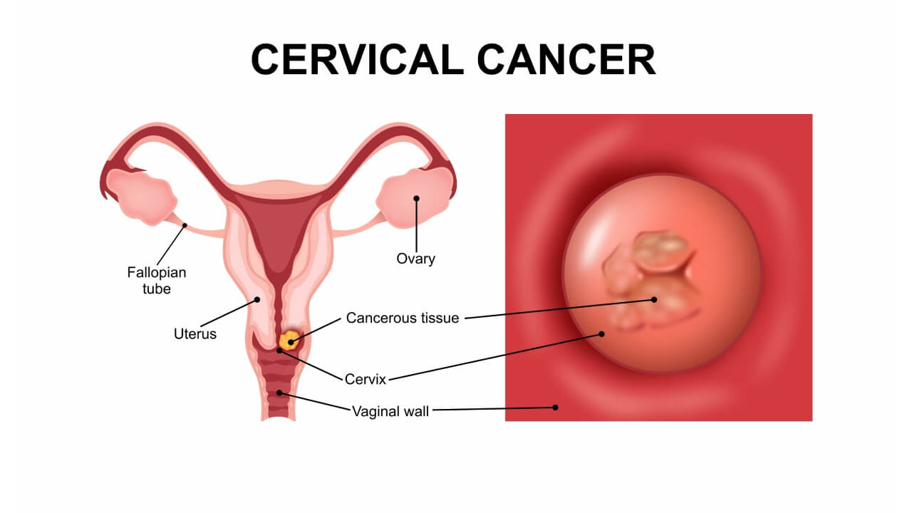 Booking Health Unveils New Study: Role of Immunotherapy in Extending Life Expectancy for Stage 4 Cervical Cancer Patients