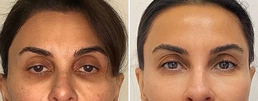 Epione Beverly Hills Releases Landmark Study Led by Dr. Simon Ourian Confirming Long-Term Effectiveness of Non-Surgical Under-Eye Dark Circle Treatment