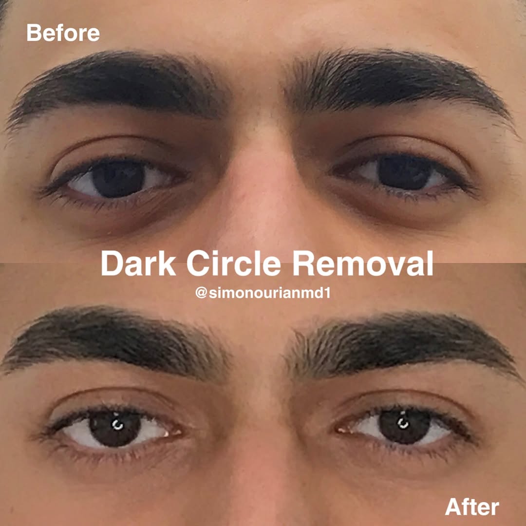 Epione Beverly Hills Releases Landmark Study Led by Dr. Simon Ourian Confirming Long-Term Effectiveness of Non-Surgical Under-Eye Dark Circle Treatment