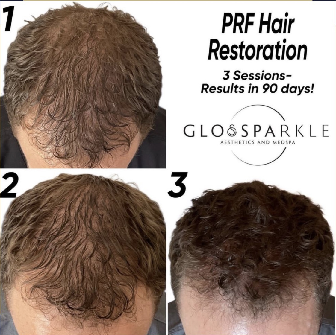 Glo & Spa-rkle Aesthetics and Medical Spa Launches Revolutionary Near-Painless and Precise PRP and PRF Hair Restoration Intradermal Injector Treatment