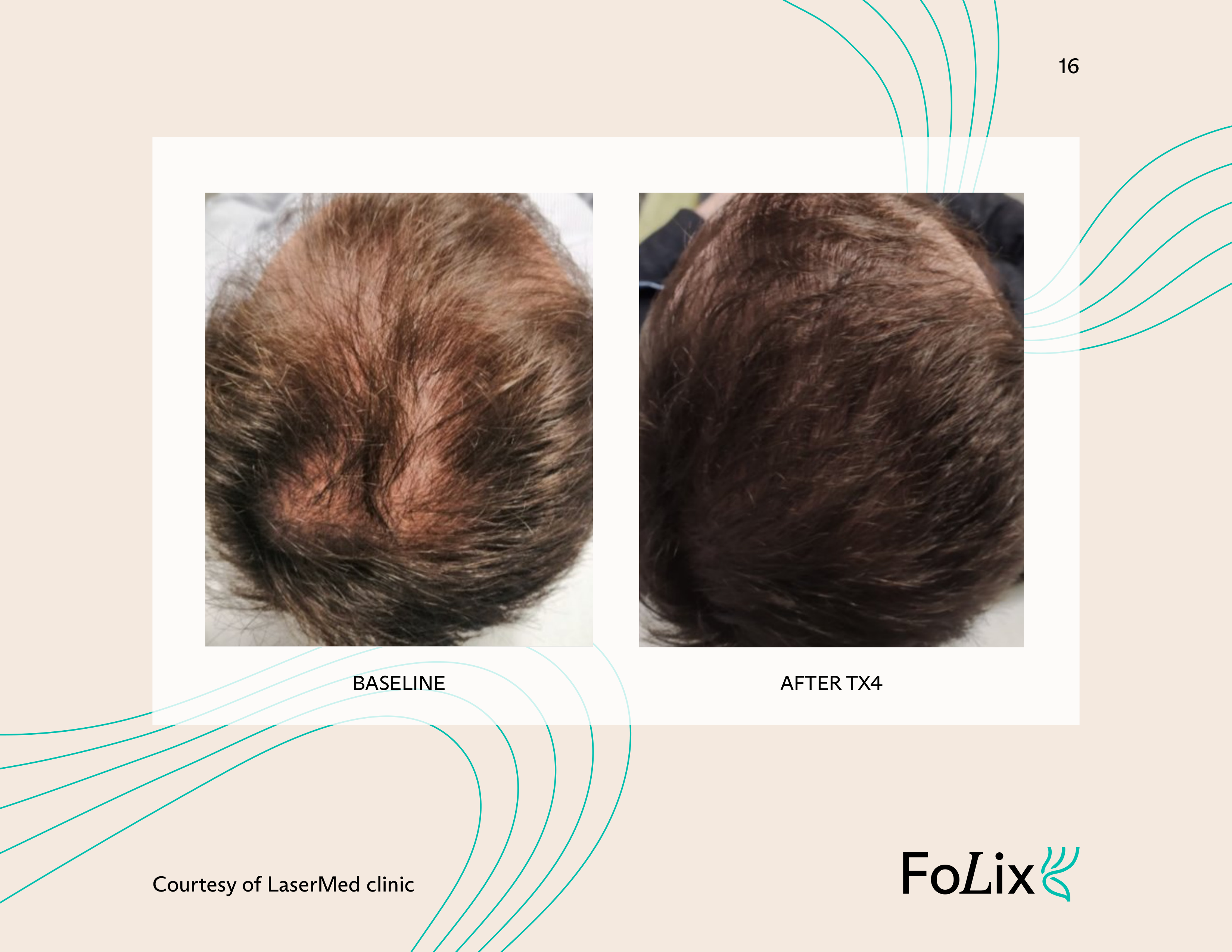 Pure Radiance Medispa Introduces Seattle’s First FDA-Cleared, Needle-Free Hair Growth Laser With Zero Downtime